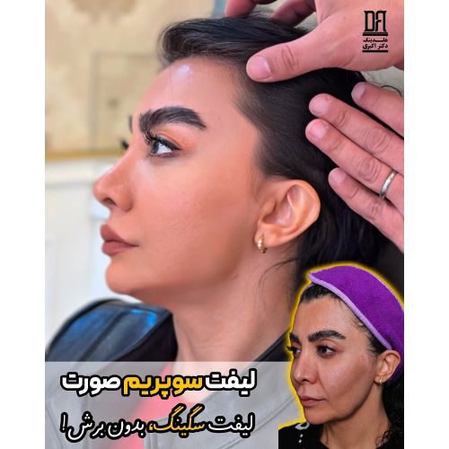 لیفت سوپریم صورت و لیفت سگینیگ بدون برش در هلدینگ دکتر اکبری