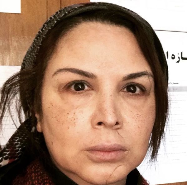 صورت شهره سلطانی چی شده؟ + عکس