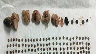 خروج بیش از 150 تکه سنگ از کلیه یک بیمار/تصویر