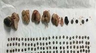 خروج بیش از 150 تکه سنگ از کلیه یک بیمار/تصویر