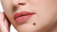 چه خال‌هایی خطرناک هستند؟