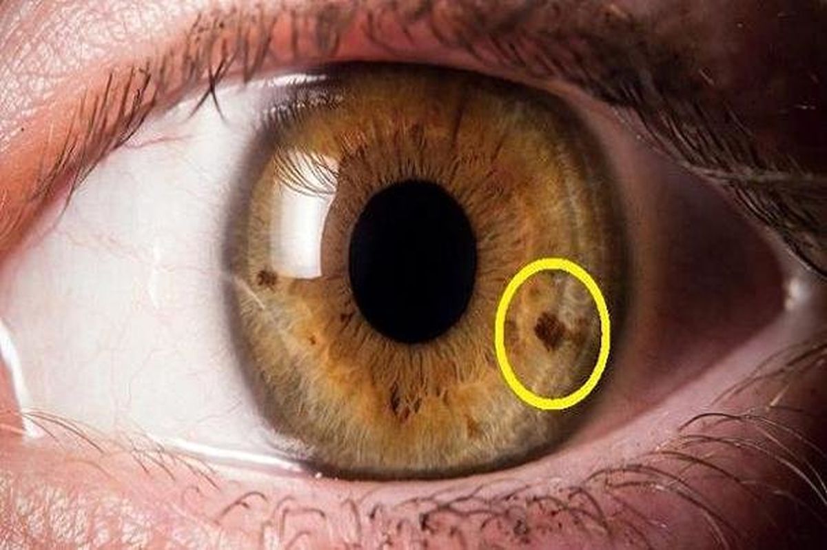 لک های درون چشم نشان از چه مشکلی است؟