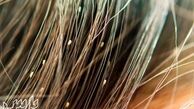علت شپش سر چیست ؟  درمان موثر شپش سر در کودکان 