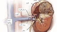 دلایل بروز بیماری مثانه عصبی