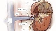 دلایل بروز بیماری مثانه عصبی