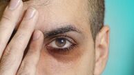 
چرا زیر چشم‌ ها تیره میشه؟
