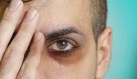 
چرا زیر چشم‌ ها تیره میشه؟
