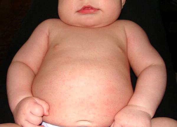 راه درمان گرمازدگی کودکان را بدانید