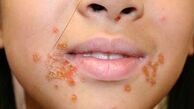 شیوع عفونت های پوستی از چاله به چاه افتادن زنان برای زیباشدن