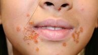 شیوع عفونت های پوستی از چاله به چاه افتادن زنان برای زیباشدن