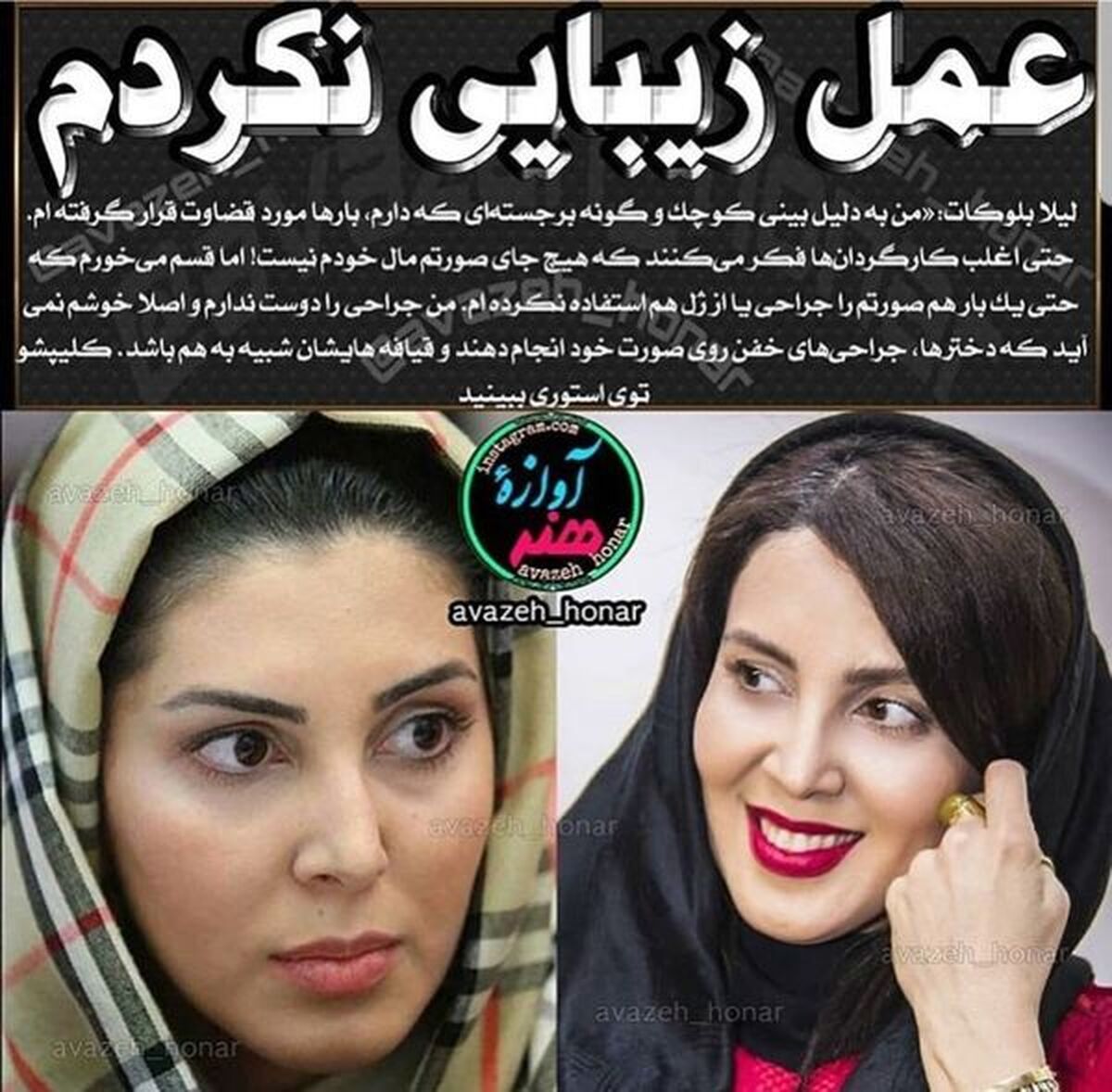توضیح خانم بازیگر در مورد عمل زیبایی اش+عکس