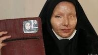 ابهام در ختم پرونده قربانیان اسیدپاشی اصفهان