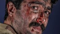 صورت حسین مهری زخمی شد + عکس