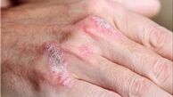 راه های درمان خشکی پوست در زمستان
