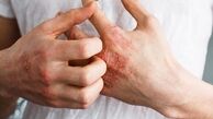برای رفع خارش پوست دست از چه کرمی استفاده کنیم؟