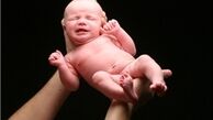 احتمال ابتلای نوزادان به سرطان در باروری از طریق "IVF"