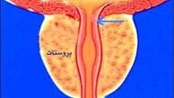علائم هشدار دهنده پروستات بزرگ