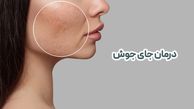 سریعترین روش از بین بردن جای جوش