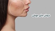 سریعترین روش از بین بردن جای جوش