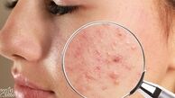 از بین بردن جای زخم قدیمی با 15 تکنیک خانگی و کلینیکی