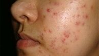  مکانیسم بروز جوش در بدن از دیدگاه طب سنتی 