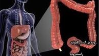 باکتری‌ دندان باعث سرطان روده می‌شود 
