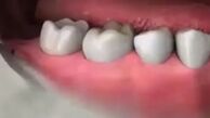 هر آنچه باید درباره دندان های عقل بدانید