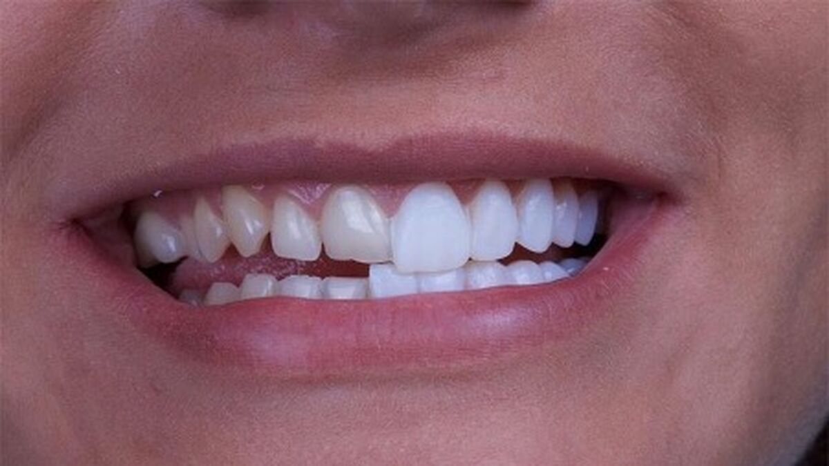 بررسی مهمترین عوارض کامپوزیت و لمینت 