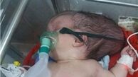 جمجمه این نوزاد نصفه است+تصاویر