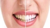 چگونه زردی دندان هایمان را رفع کنیم؟