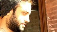 صورت آفتاب خورده بنیامین خان + عکس