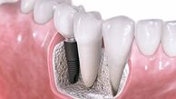  سن مناسب برای اقدام به ایمپلنت 