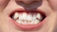 روش خانگی برای صاف شدن دندان