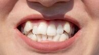 روش خانگی برای صاف شدن دندان
