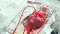 يک ماده واحده براي 80 سال سابقه پيوند اعضا در ايران!