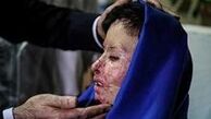 
قربانی اسیدپاشی به آمریکا رفت
