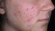 آکنه های پوستی همیشه مضر نیست!