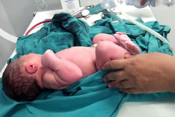 ابتلا به کرونا باعث زایمان زودرس می‌شود؟ 