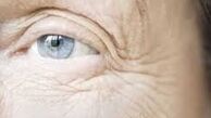 نکاتی طلایی برای رهایی از چین و چروک اطراف چشم 