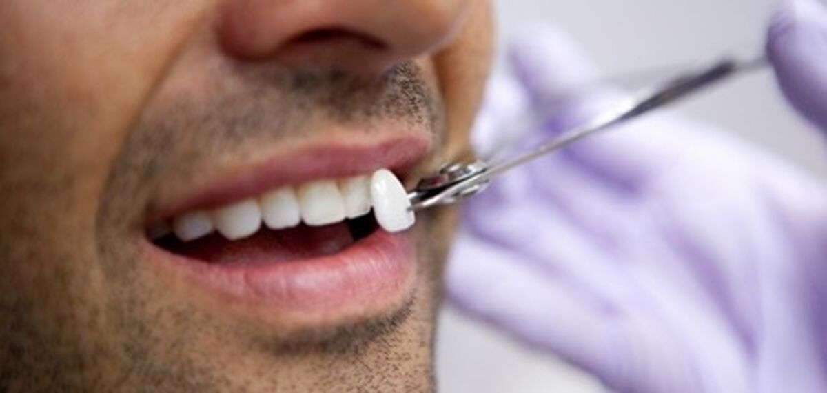 7 علت مهم زرد شدن دندان ها