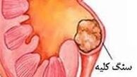 مصرف بیش از حد ویتامین C، سنگ کلیه می‌آورد