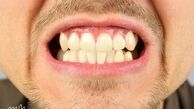 علت دندان قروچه در روز و شب چیست ؟ عوارض ؛ پیشگیری ؛ درمان